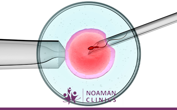 شروط نجاح الحقن المجهري | 8 علامات لنجاحه