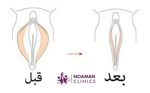 عملية تجميل الشفرتين قبل وبعد