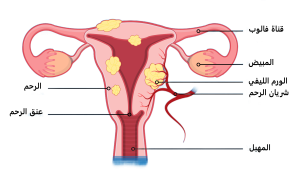 شكل الورم الليفي في الرحم