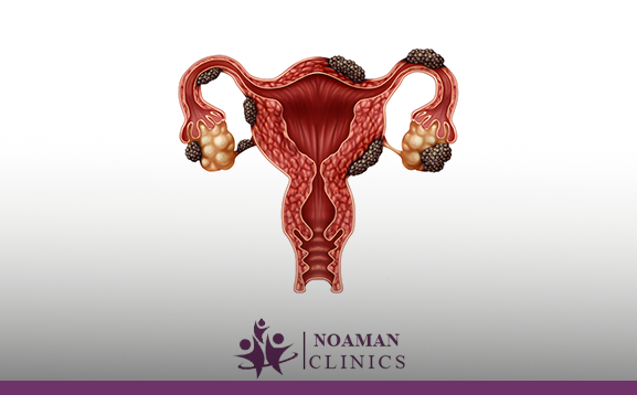 اسباب بطانة الرحم المهاجرة