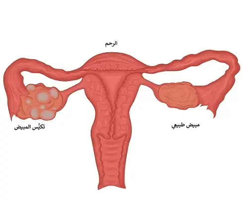 تكيس المبايض عند البنات بالصور